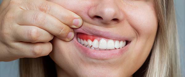 Gingivoplastika