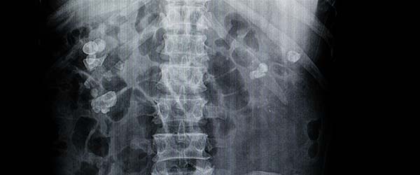Ureterorenoskopija
