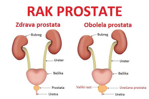 Rak prostate simptomi