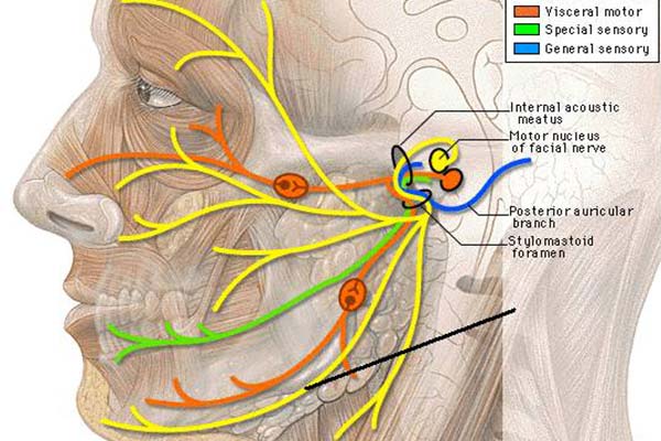 Neuralgija trigeminusa