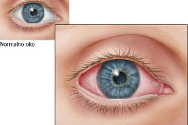 Alergijski konjunktivitis
