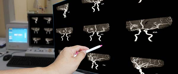 Rekonstrukcija Karotidne Arterije