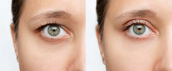 Blefaroplastika