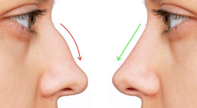 Rinoplastika