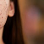 Rosacea