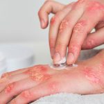 psorijaza