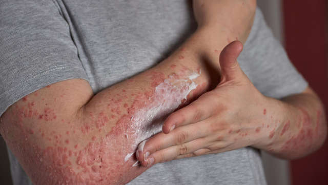 Ekcem i psorijaza